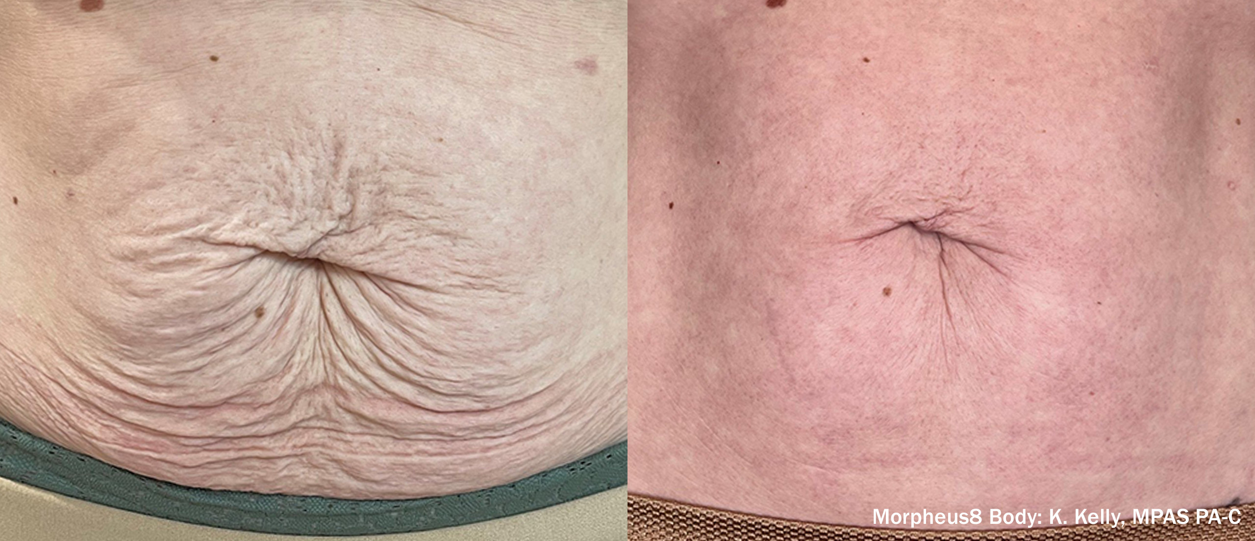 Morpheus8 before and after — Body Area (24 Weeks)