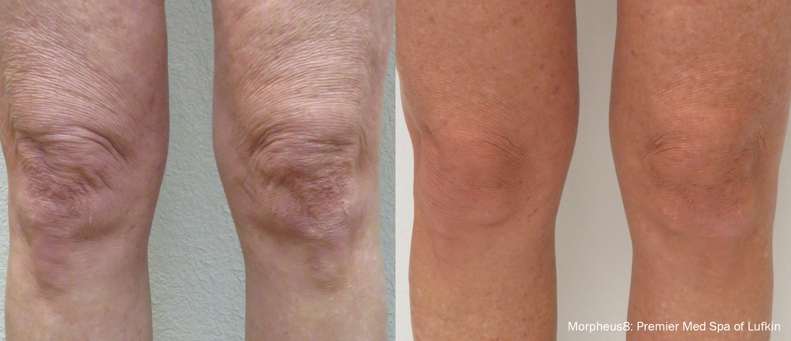 Morpheus8 before and after — Neck & Lower Face