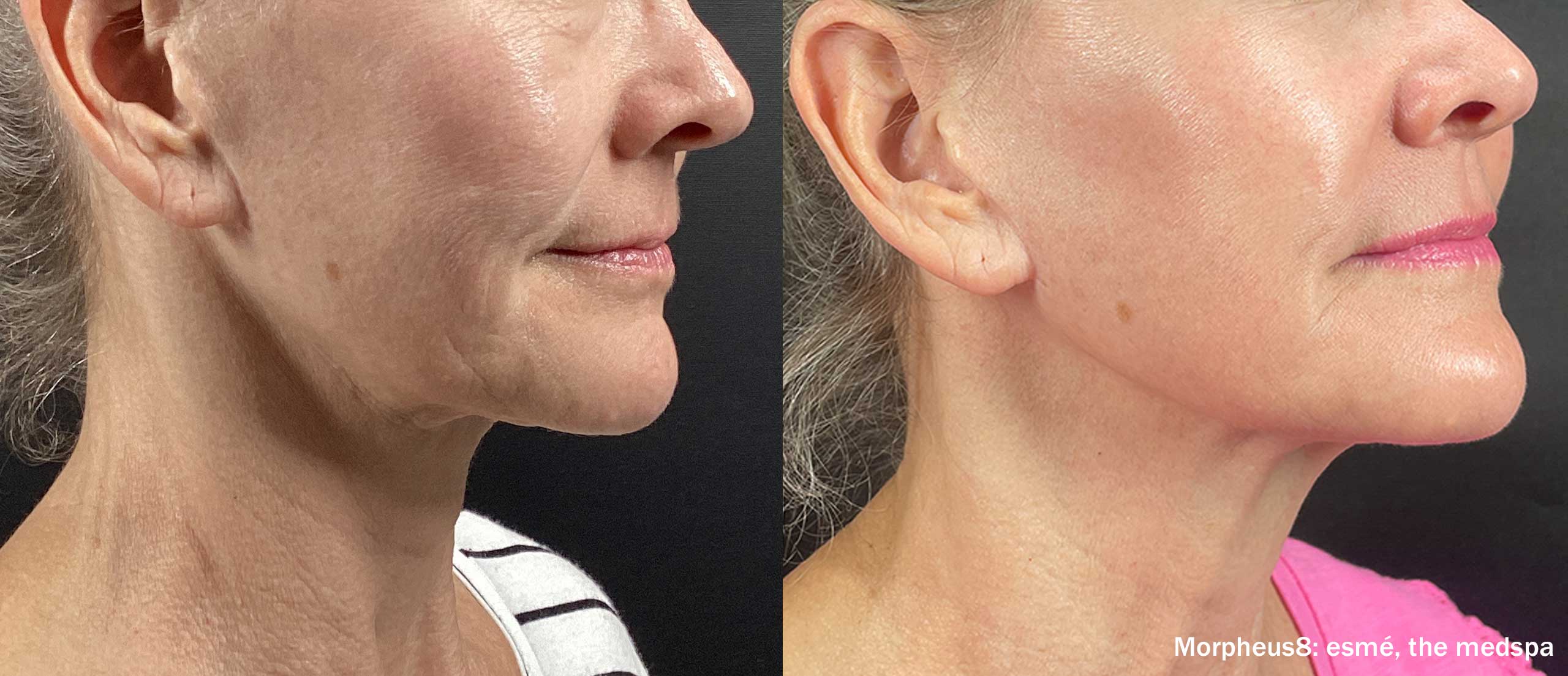 Morpheus8 RF Microneedling Treatment