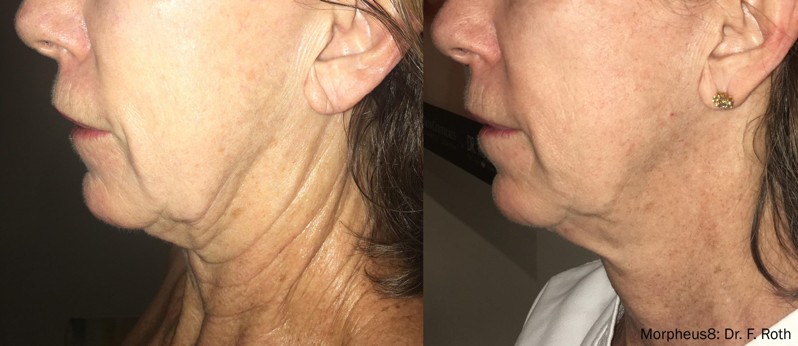 Morpheus8 before and after - facial skin tightening